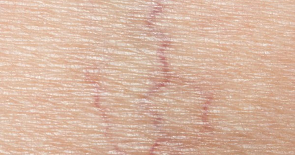 Spider Veins Guide: Causes, Symptoms and Treatment Options