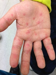手足口病