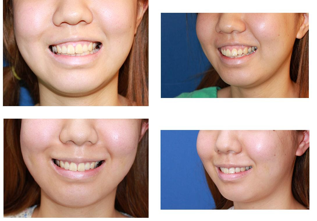 鼻柱下降術 ガミースマイル修正術 メールの問い合わせ 鼻の手術 に対する返信