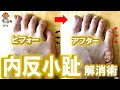 上 足裏 内反小指 366785