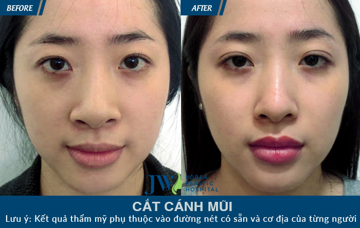 Thu gọn cánh mũi mất bao nhiêu tiền?