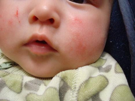 乳児湿疹 まごの顔