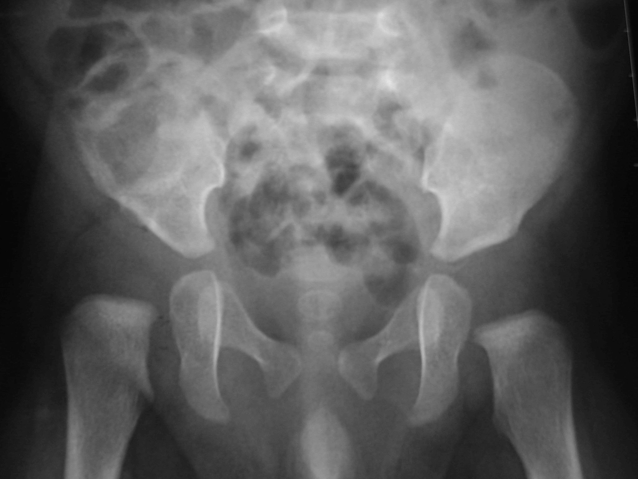 Articulation De Hanche Osteo Stop