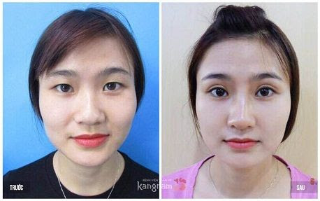 Hiệu quả bấm mí có an toàn không?