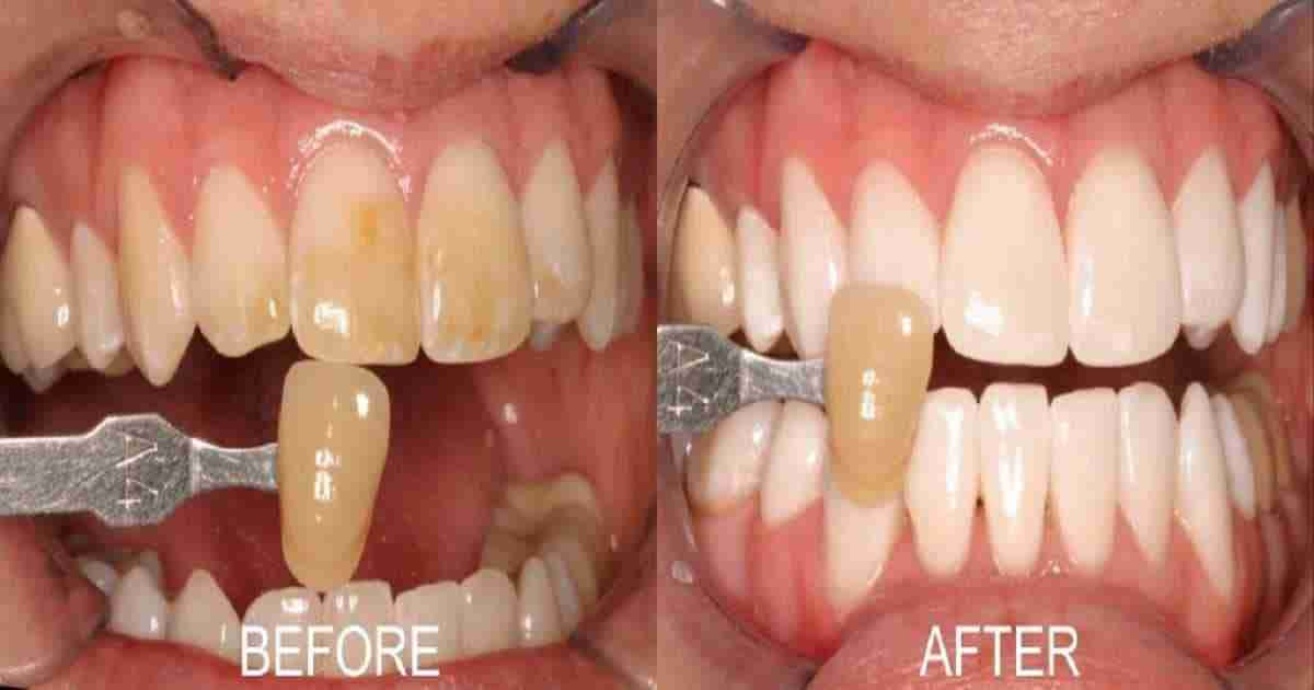 Homemade pearly whites – A guide on how to whiten your ...