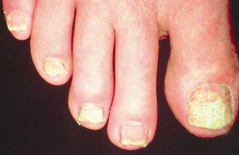 Dry Brittle Toenails