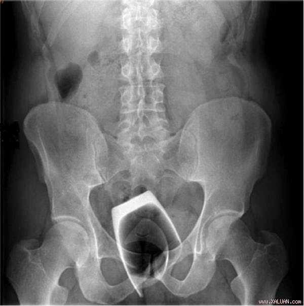  Phim chụp X-quang của bệnh nhân. Anh: BMJ.