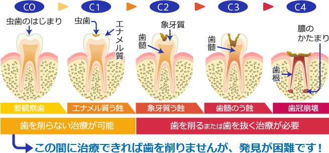 虫歯の症状・虫歯の治療 / 奈良県 上牧町の歯医者さん 西川歯科医院
