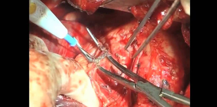 Sarcomatoid Mesothelioma Of Pleural : Pleural plaques | Image | Radiopaedia.org