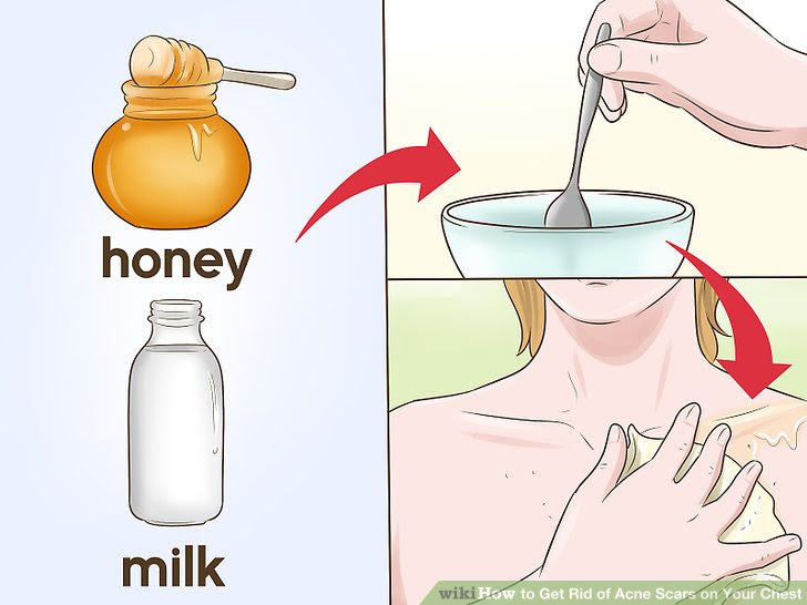 Get Rid of Acne Scars on Your Chest Step 13.jpg