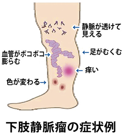 足の血管の病気 さがみはら南区 タウンニュース