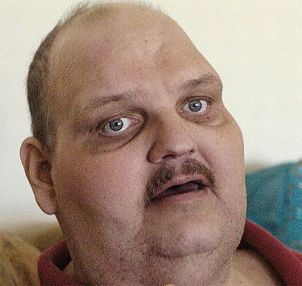 Patrick Duel and his weight loss (18 pics) Patrick Duel and his weight loss (18 pics)