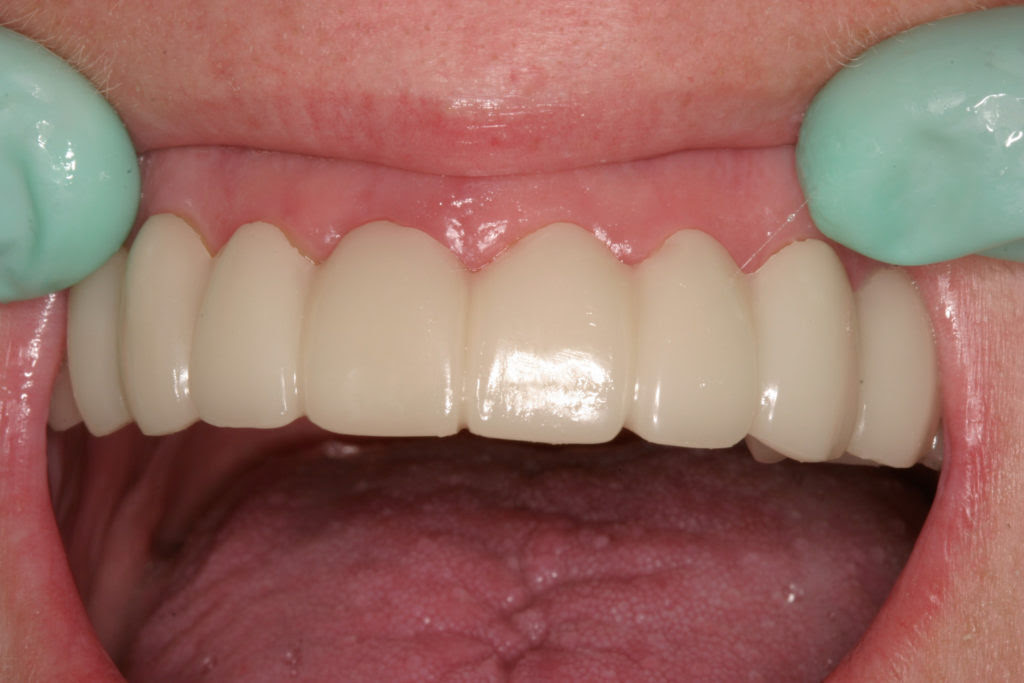 Snap On Smile
