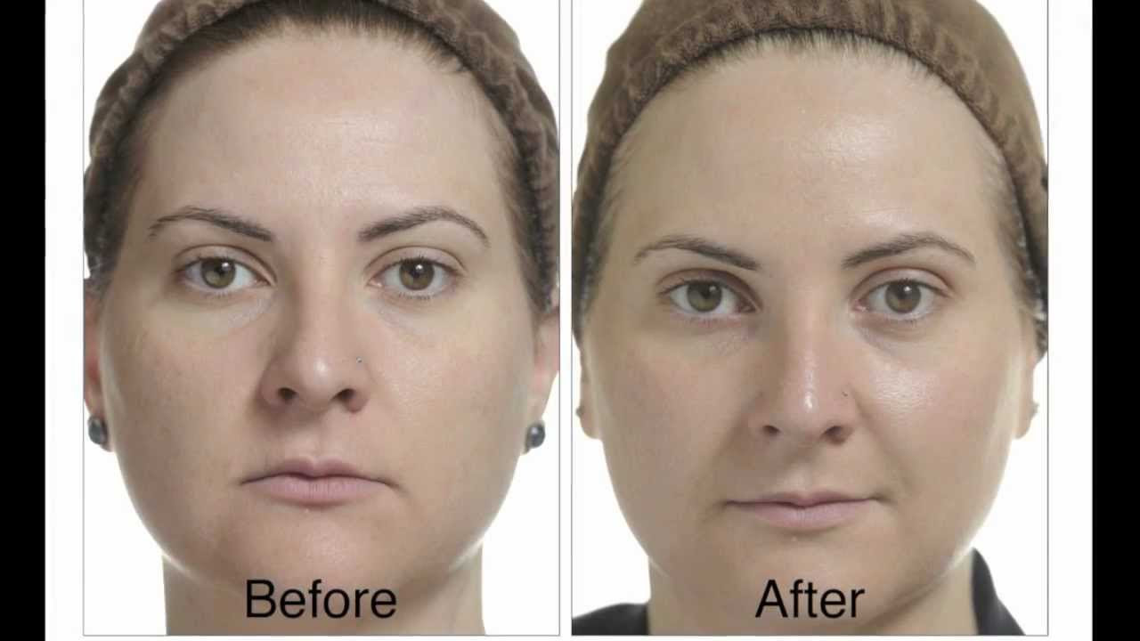 What Happens After Chemical Peel Chemical Peel Microdermabrasion