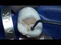 How Long Does A Filling Take?