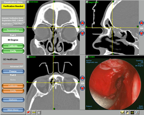 Image Guided Endoscopic Sinus Surgery Phoenix Arizona Sinus Center