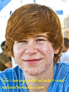 Natural Remedies For Cystic Acne - Home Remedies for Acne
