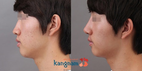 nâng mũi cấu trúc 4D siêu âm-8