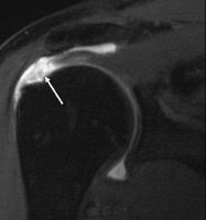 rotator cuff tear