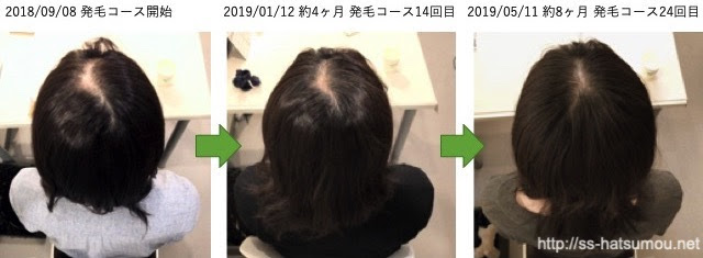 越谷市 代女性の発毛 分け目 頭頂部の頭皮の目立つ薄毛が劇的に改善しました