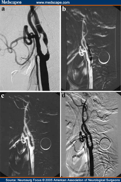internal carotid artery 12