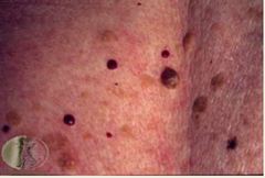 Cherry Angioma in Adults - Removal, Pictures, Treatment