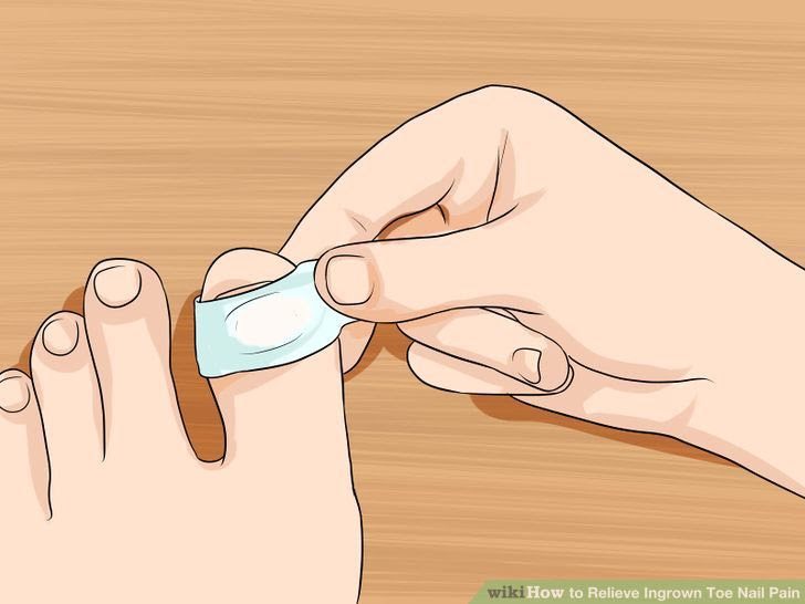 Relieve Ingrown Toe Nail Pain Step 11 Version 3.jpg