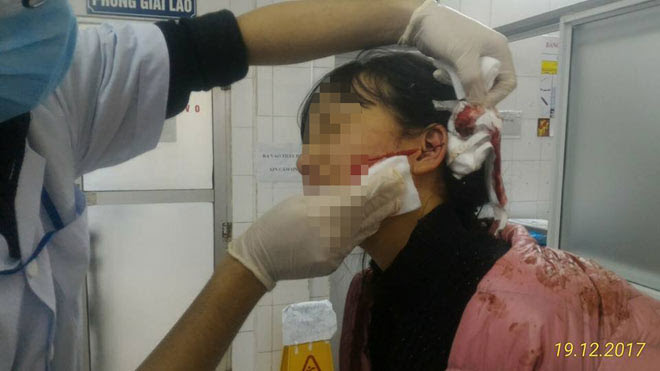 Nữ sinh cấp 3 xinh đẹp bị đâm rách mặt vì mâu thuẫn ngoài chợ - 1