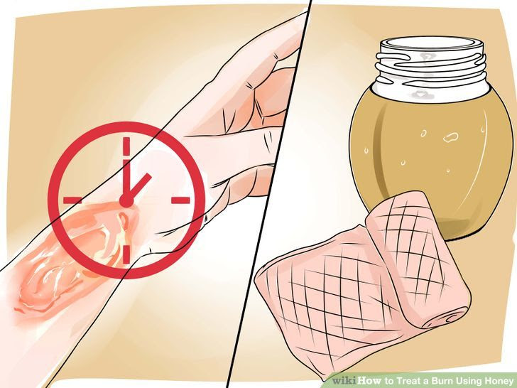 Treat a Burn Using Honey Step 19.jpg