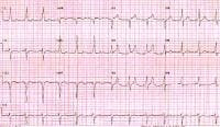 Wolff-Parkinson-White pattern. Note the short PR i