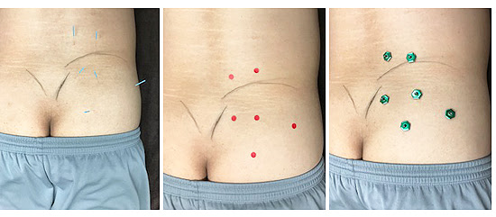 坐骨神経痛に強い 滋賀県大津からすぐ 山科ひで鍼灸接骨院