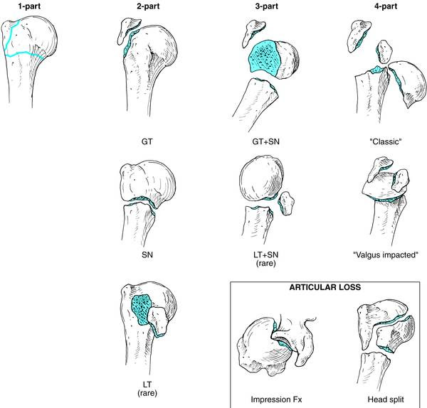 humerus bone anatomy. Proximal Humeral Fractures