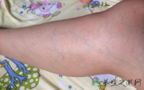 静脉曲张手术后吃什么药 聪康网