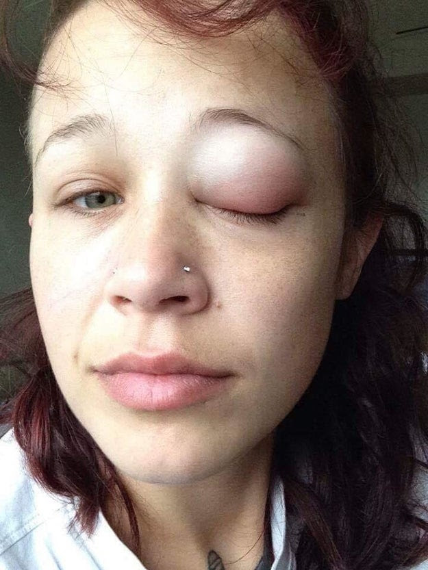However, due to what Gallinger describes as a mixture of "undiluted ink, over injection, and not enough/smaller injections [sites]" the tattoo became infected and by the next morning her eye was swollen shut.