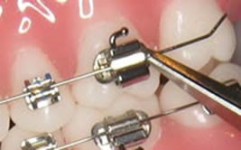 Braces - Ace Braces O'Regan Orthodontics | Teeth ...