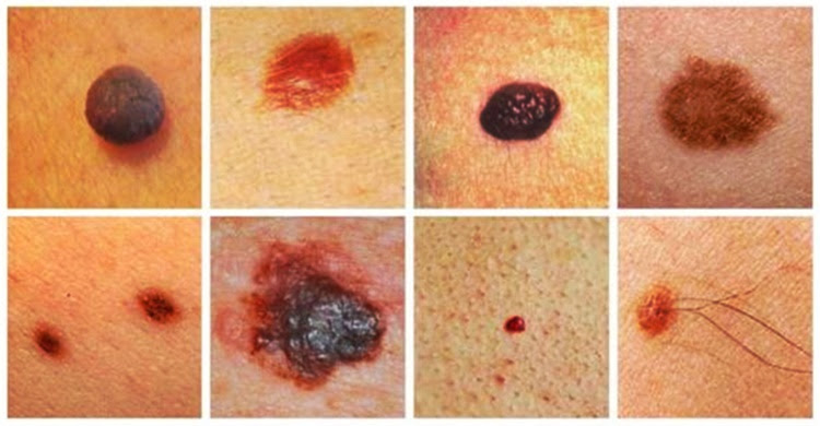 Skin Cancer Ways To Check This Kind Of Disease Using Smartphone