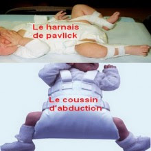 Luxation Congenitale De Hanche Bebesante Fr