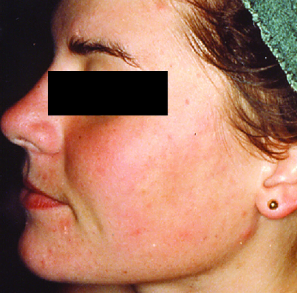 does baking soda cast off acne scars