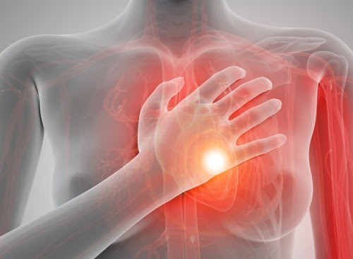 infarto