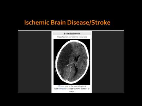 ECG in myocardial ischemia: ischemic changes in the ST