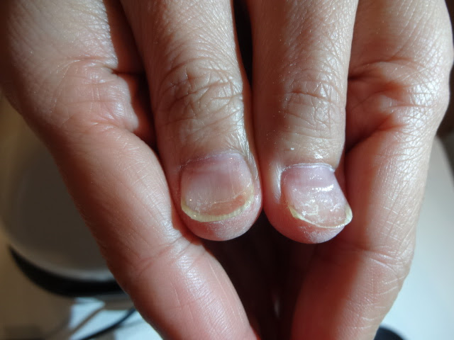 大阪淀川区 西淀川区 ビジュール Nail Bar ボコボコ へこみ爪 大阪 西淀川区 淀川区 ｂijour ビジュール Nail Bar