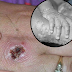 Monkeypox Scars - Other Viral Infections Of The Skin Springerlink / Here's what you need to know about the virus, how it is spread, and how that spread can be stopped.