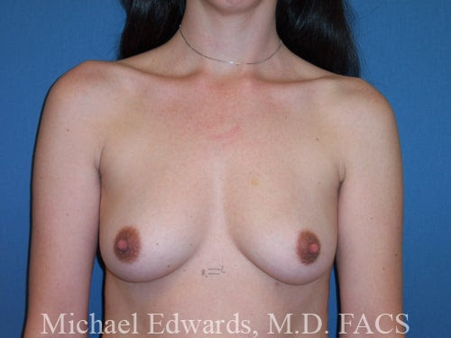 saline breast implants. reast augmentation - 34B