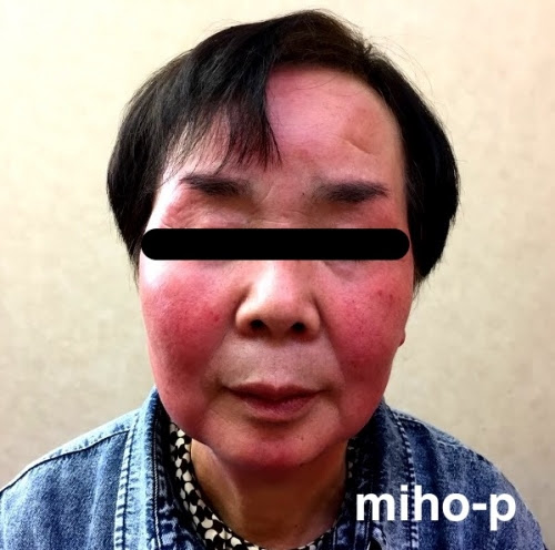 皮膚病事例一覧 美保薬局 福島県いわき市の皮膚病お悩み相談専門の経験豊富な薬局です