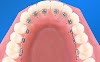 Phù thủy niềng răng - Tâm sự ưu nhược điểm của niềng răng mắc cài mặt lưỡi