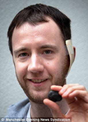 Alastair White was completely deaf in his left ear after suffering mumps