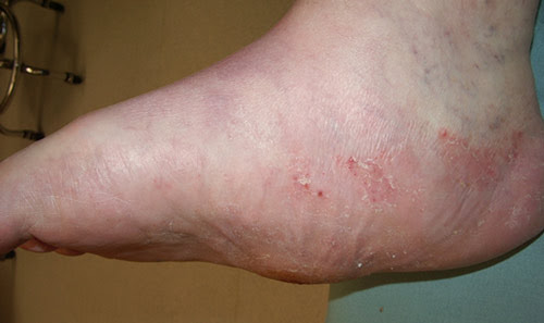 12 -Charcot Foot Deformities: A look inside this important ...