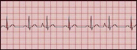 Section 6 Atrial Rhythms