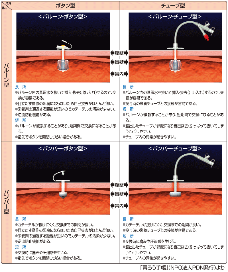 胃ろう Peg とは 胃ろう入門 Npo法人pdn