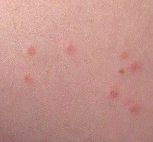 Ricerche correlate a Small bed bugs bites pictures